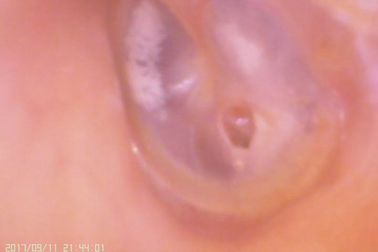 Otoscopio de Digitaces del amera video del oído y de la nariz C para la perforación de la membrana timpánica