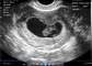 Escáner portátil del embarazo de la endocavidad transvaginal para el ultrasonido portátil OB/GYN