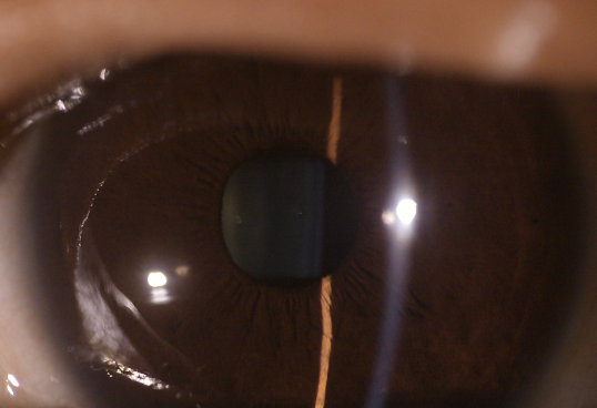 Del fondo de 3 lente anterior Digitaces del equipo de la lente de la cámara del ojo del ojo superficial oftálmico disponible de la cámara reemplazable