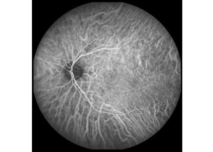 equipo oftálmico Ultra-ancho de Angiograph Digital de la retina de la exploración del laser del campo con el zoom óptico 100°/60°/30°