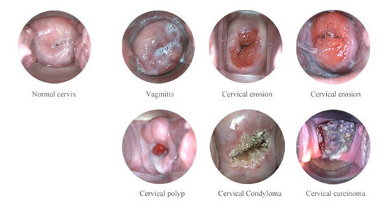 Colposcopio electrónico digital portátil