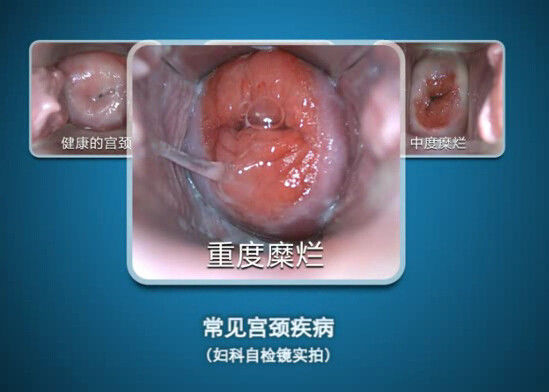El endoscopio de Digitaces Uno mismo-examina mini Colposcopy del Colposcope con la gama de la observación 70~100m m
