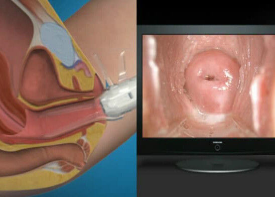 El endoscopio de Digitaces Uno mismo-examina mini Colposcopy del Colposcope con la gama de la observación 70~100m m