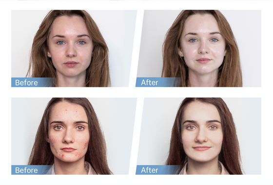 Último aplicador de suero automático de 4 polos EMS Hydra Pen H5 Face Skin Derma Microneedling Pen Essence Regeneración de colágeno