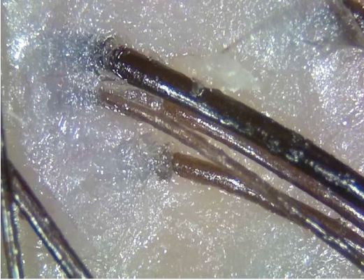 El dispositivo inalámbrico portátil de la diagnosis de la telemedicina del analizador de la piel de Digitaces con polariza la luz